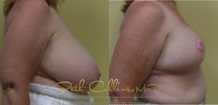 Before & After Breast Reduction Case 38 View #3 View in Guilford, CT