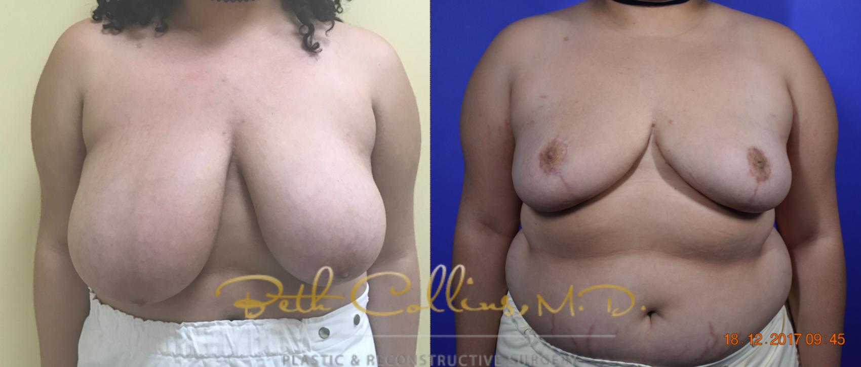 Before & After Breast Reduction Case 39 View #1 View in Guilford, CT