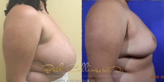 Before & After Breast Reduction Case 39 View #2 View in Guilford, CT