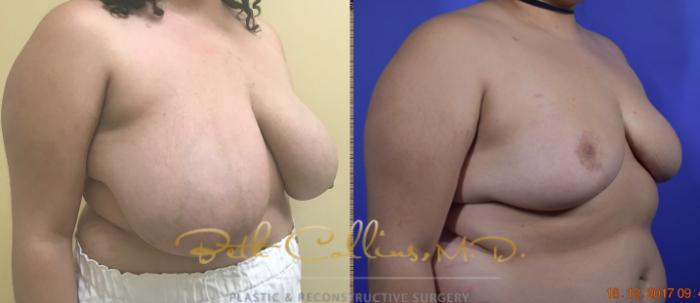 Before & After Breast Reduction Case 39 View #3 View in Guilford, CT