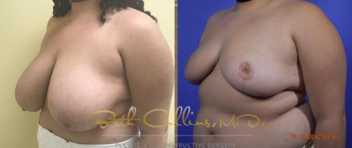 Before & After Breast Reduction Case 39 View #4 View in Guilford, CT
