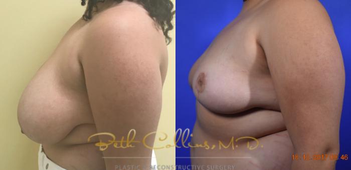 Before & After Breast Reduction Case 39 View #5 View in Guilford, CT