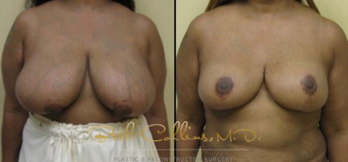 Before & After Breast Reduction Case 40 View #1 View in Guilford, CT