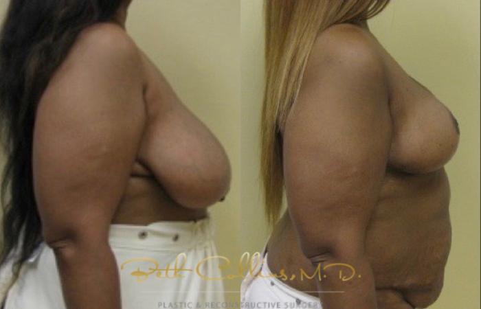Before & After Breast Reduction Case 40 View #2 View in Guilford, CT