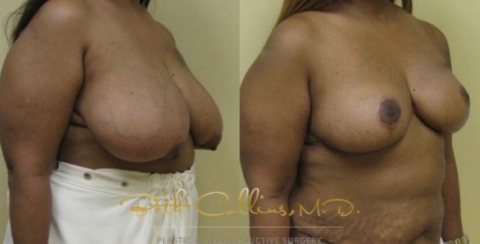 Before & After Breast Reduction Case 40 View #3 View in Guilford, CT