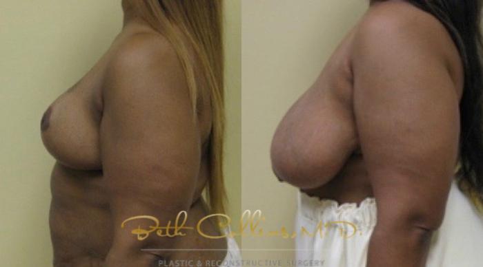 Before & After Breast Reduction Case 40 View #4 View in Guilford, CT