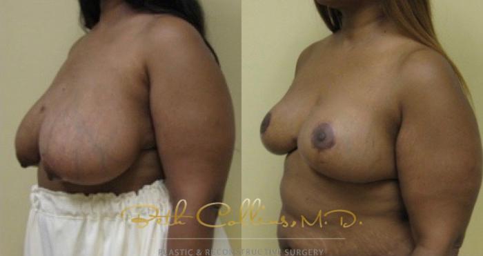 Before & After Breast Reduction Case 40 View #5 View in Guilford, CT