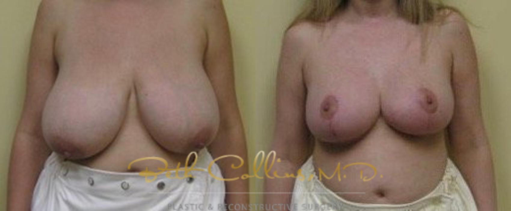 Before & After Breast Reduction Case 41 View #1 View in Guilford, CT