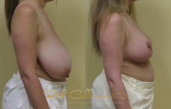 Before & After Breast Lift Case 41 View #2 View in Guilford, CT