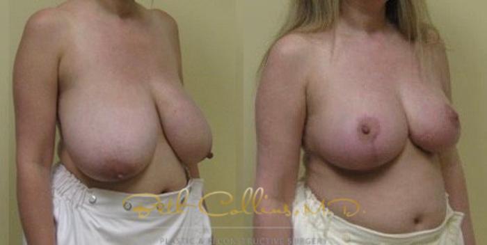 Before & After Breast Lift Case 41 View #3 View in Guilford, CT