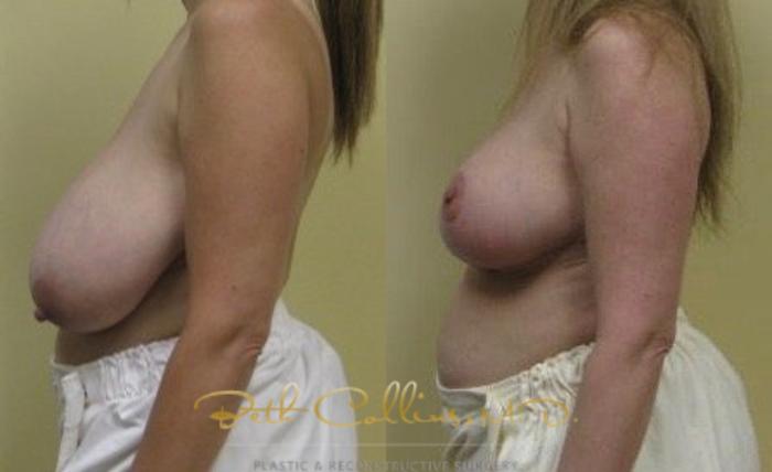Before & After Breast Reduction Case 41 View #4 View in Guilford, CT