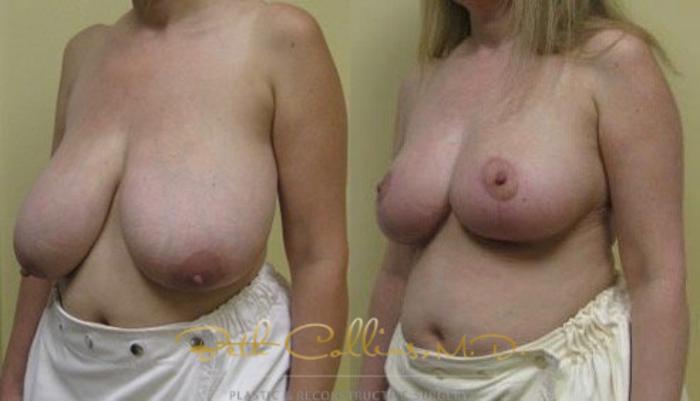 Before & After Breast Reduction Case 41 View #5 View in Guilford, CT
