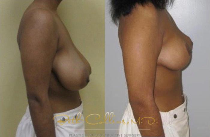 Before & After Breast Reduction Case 42 View #2 View in Guilford, CT