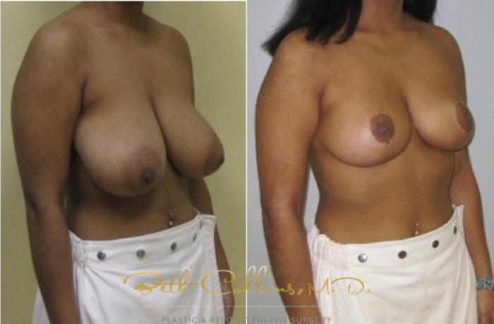 Before & After Breast Reduction Case 42 View #3 View in Guilford, CT