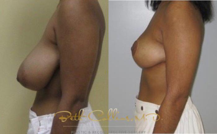 Before & After Breast Reduction Case 42 View #4 View in Guilford, CT