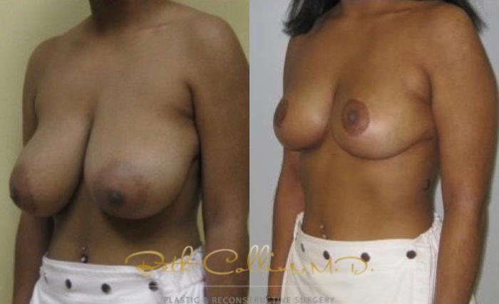 Before & After Breast Reduction Case 42 View #5 View in Guilford, CT