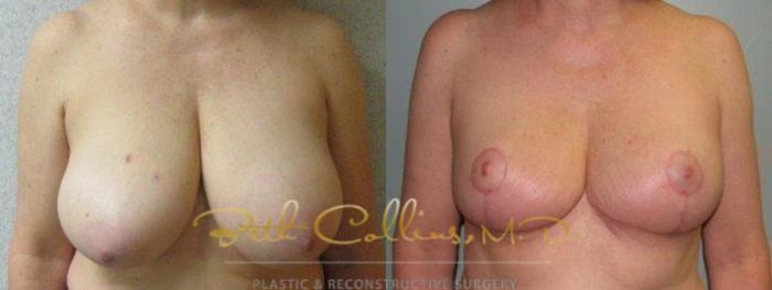 Before & After Breast Lift Case 43 View #1 View in Guilford, CT