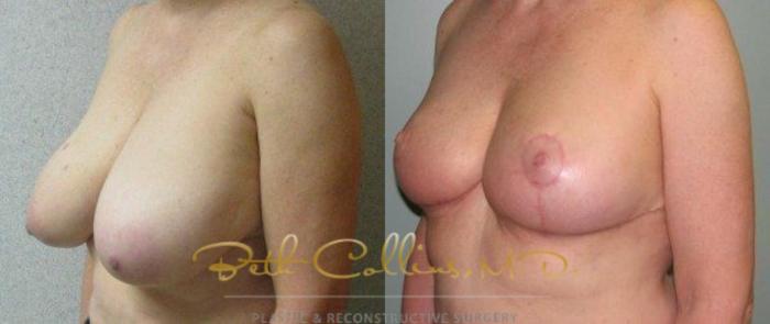 Before & After Breast Reduction Case 43 View #2 View in Guilford, CT