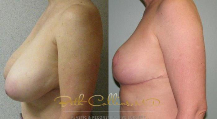 Before & After Breast Reduction Case 43 View #3 View in Guilford, CT