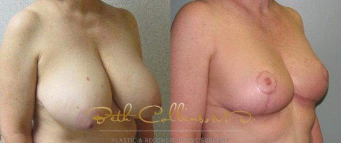 Before & After Breast Lift Case 43 View #4 View in Guilford, CT