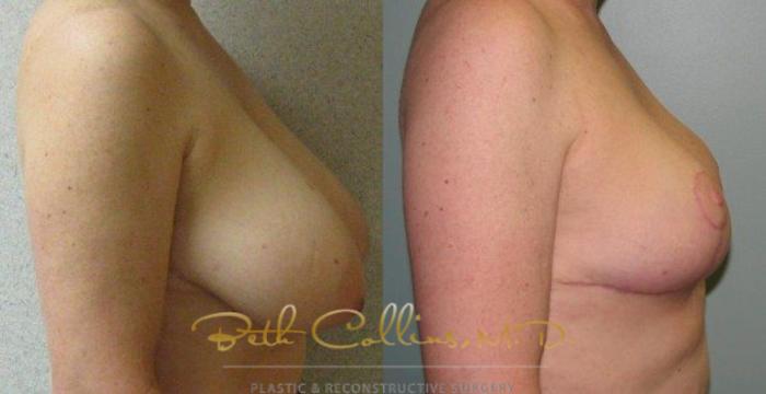 Before & After Breast Lift Case 43 View #5 View in Guilford, CT