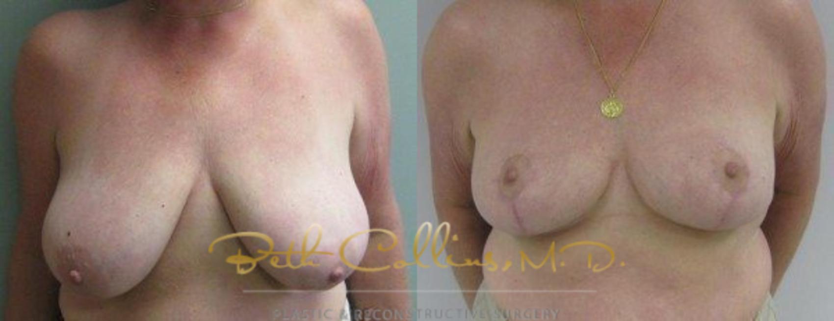 Before & After Breast Lift Case 44 View #1 View in Guilford, CT