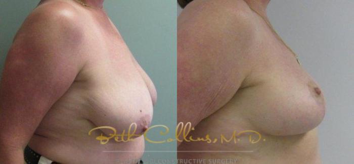 Before & After Breast Reduction Case 44 View #2 View in Guilford, CT