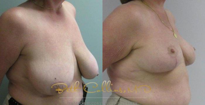 Before & After Breast Lift Case 44 View #3 View in Guilford, CT