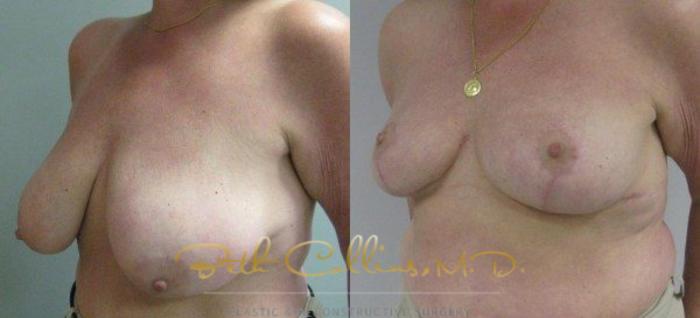 Before & After Breast Lift Case 44 View #4 View in Guilford, CT