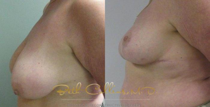 Before & After Breast Reduction Case 44 View #5 View in Guilford, CT