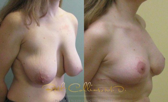 Before & After Breast Reduction Case 46 View #2 View in Guilford, CT