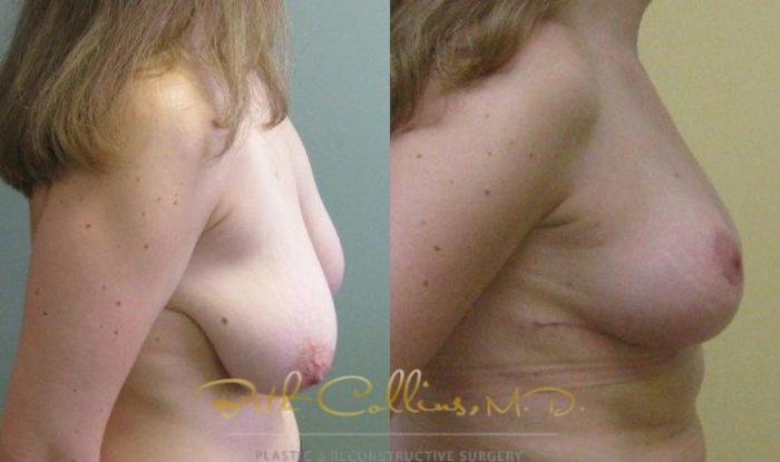 Before & After Breast Lift Case 46 View #3 View in Guilford, CT