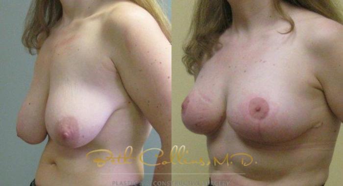 Before & After Breast Reduction Case 46 View #4 View in Guilford, CT