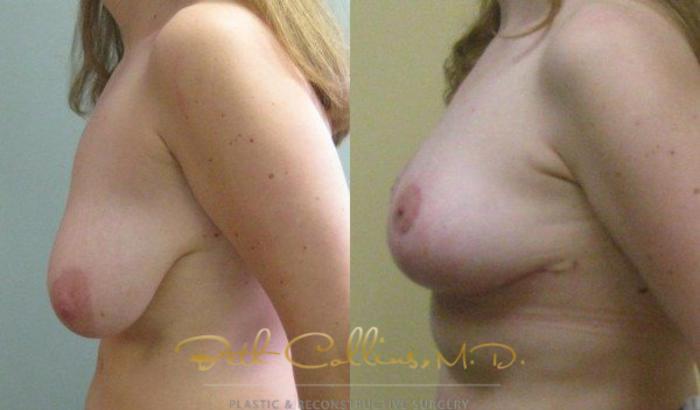 Before & After Breast Reduction Case 46 View #5 View in Guilford, CT