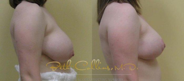 Before & After Breast Reduction Case 47 View #2 View in Guilford, CT