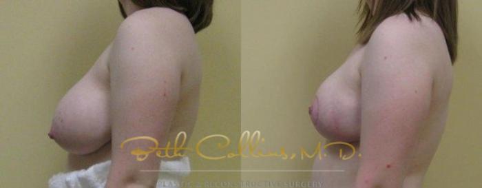 Before & After Breast Reduction Case 47 View #4 View in Guilford, CT