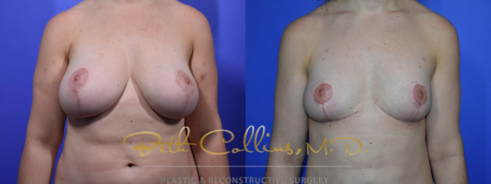Before & After Breast Reduction Case 94 View #1 View in Guilford, CT