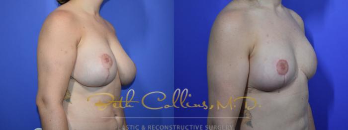 Before & After Breast Lift Case 94 View #2 View in Guilford, CT