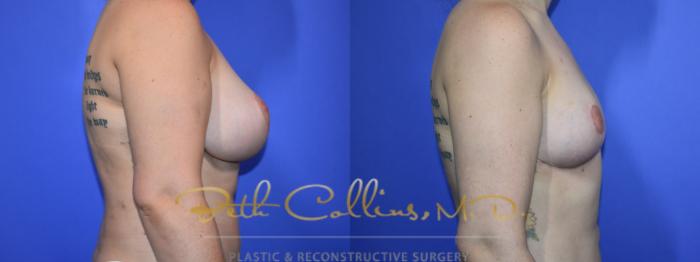 Before & After Breast Lift Case 94 View #3 View in Guilford, CT
