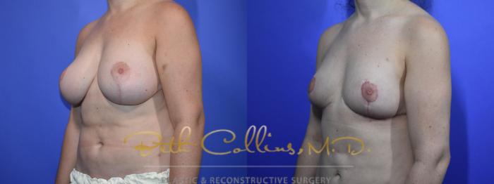 Before & After Breast Reduction Case 94 View #4 View in Guilford, CT