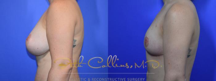 Before & After Breast Reduction Case 94 View #5 View in Guilford, CT