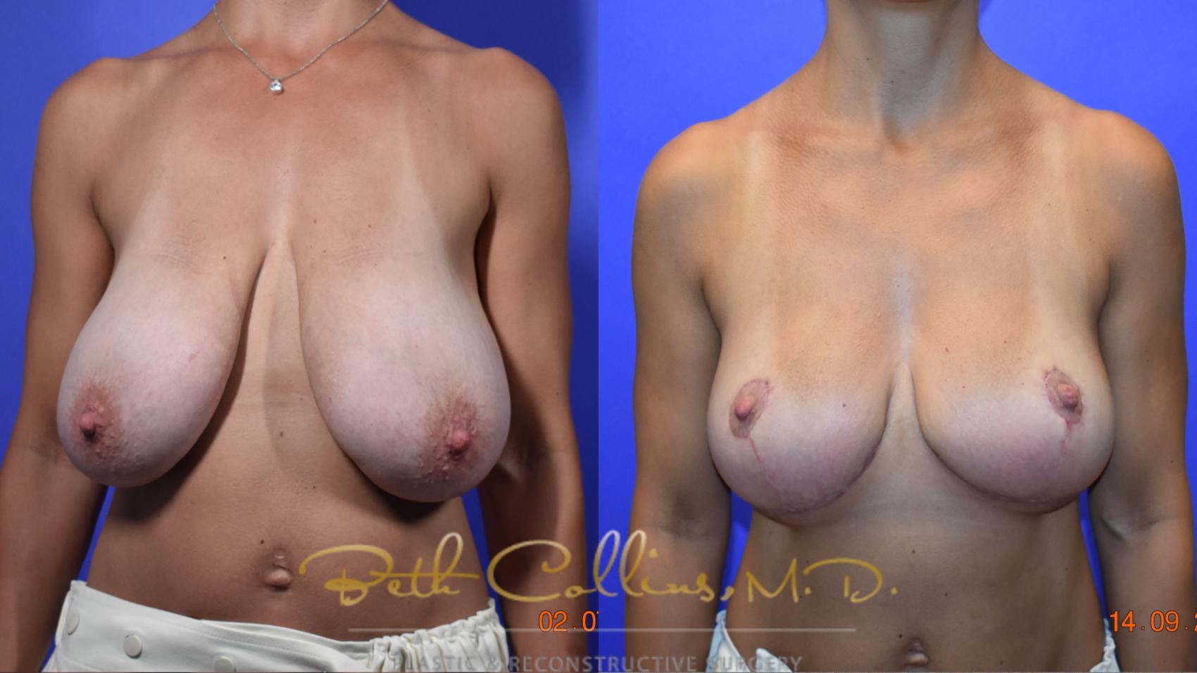 Breast Reduction Case 95 Before & After View #1 | Guilford, CT | Beth Collins M.D.