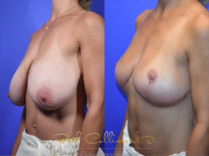 Breast reduction surgery is one of the most highly satisfactory surgeries in the field of plastics.