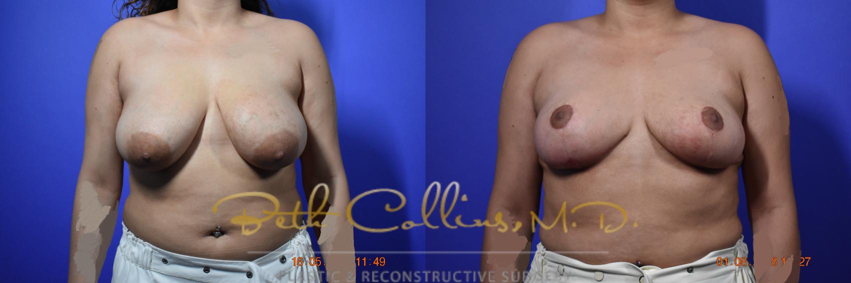 Before & After Breast Reduction Case 96 View #1 View in Guilford, CT