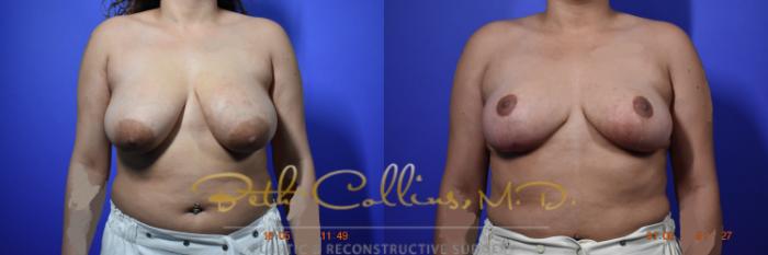 Before & After Breast Reduction Case 96 View #1 View in Guilford, CT