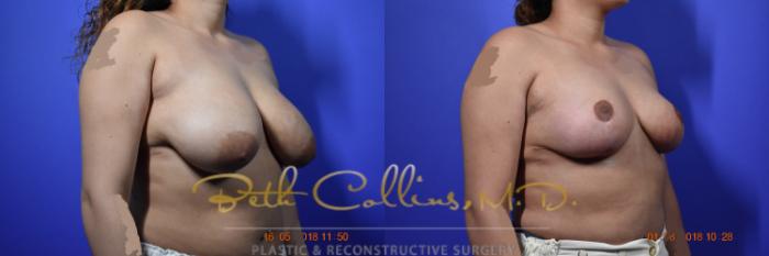 Before & After Breast Reduction Case 96 View #2 View in Guilford, CT