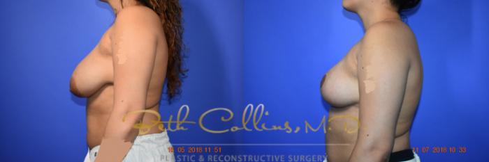 Before & After Breast Reduction Case 96 View #3 View in Guilford, CT