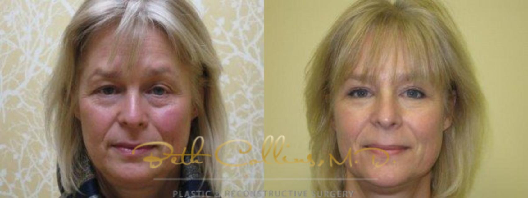 Brow Lift Case 70 Before & After View #1 | Guilford, CT | Beth Collins M.D.