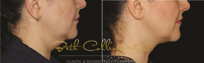 Before & After CoolSculpting® Case 163 Right Side View in Guilford, CT