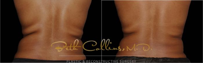 Before & After CoolSculpting® Case 165 Back View in Guilford, CT